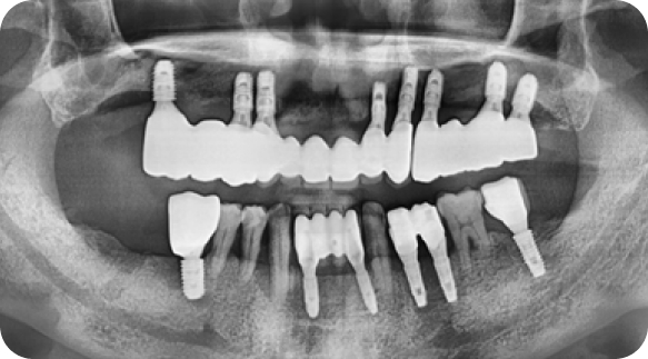 Implant 01
