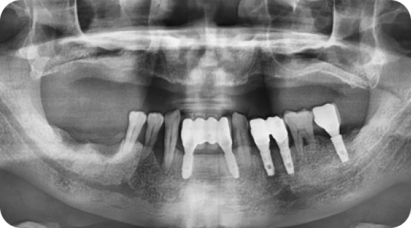 Implant 01