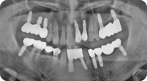 Implant 02
