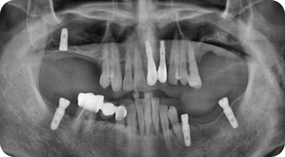 Implant 02