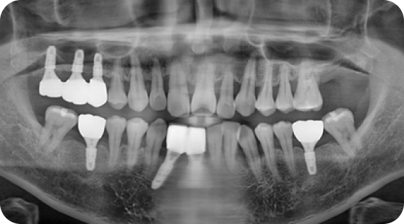 Implant 03