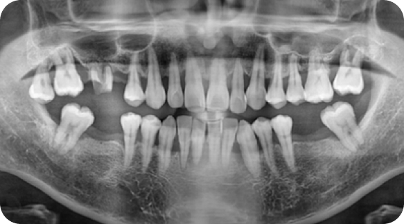 Implant 03