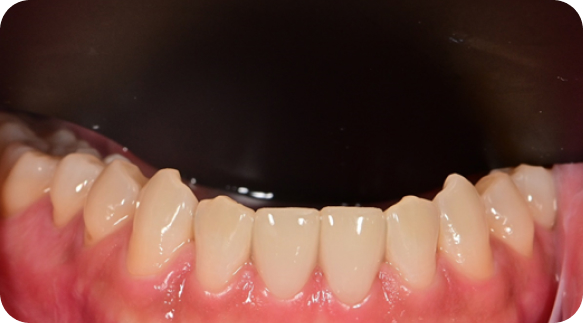Veneer 01