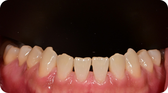 Veneer 01
