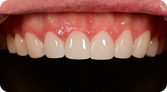 Veneer 02
