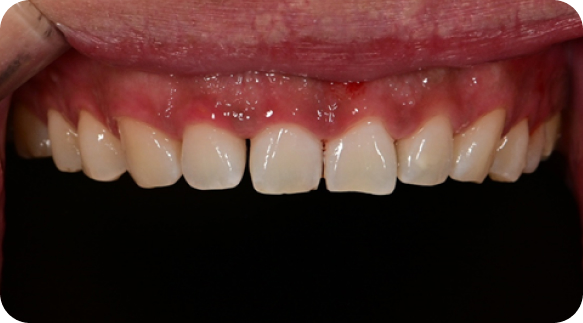 Veneer 02