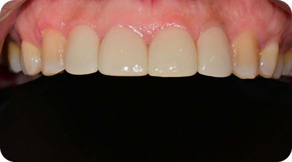 Veneer 03