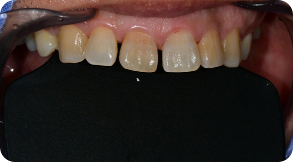 Veneer 03