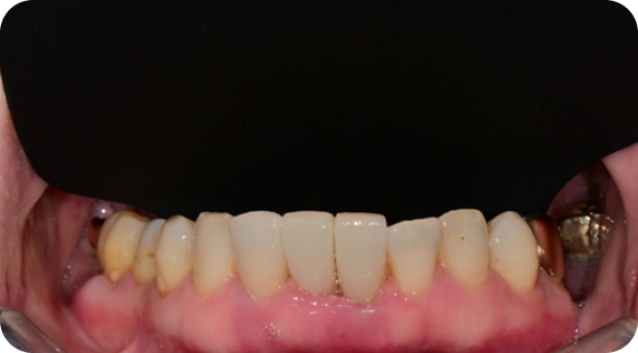 Veneer 04