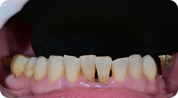 Veneer 04