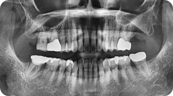 Wisdom Tooth 01