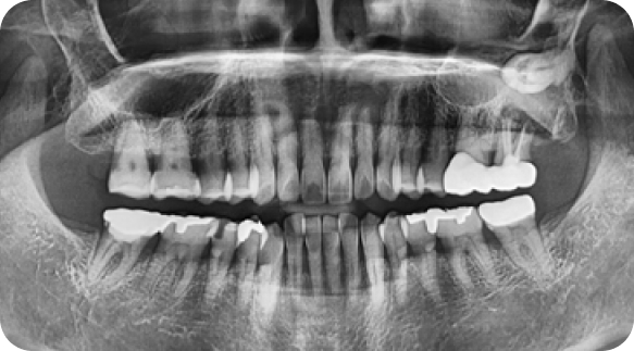 Wisdom Tooth 01