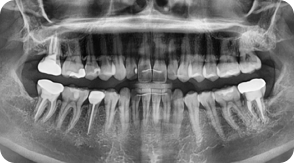 Wisdom Tooth 02