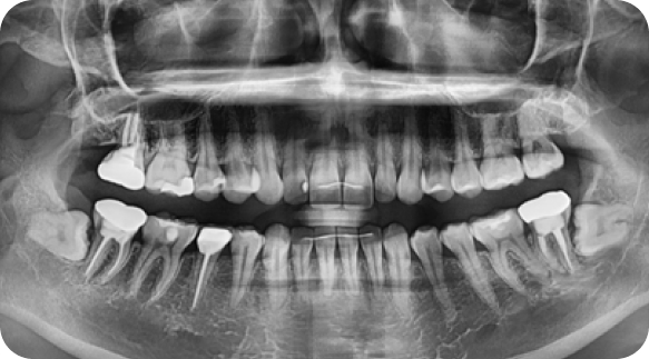 Wisdom Tooth 02