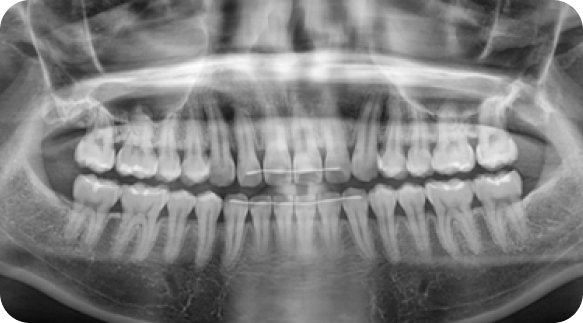 Wisdom Tooth 03