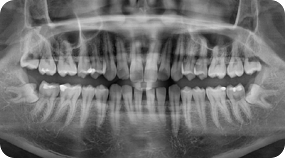 Wisdom Tooth 06