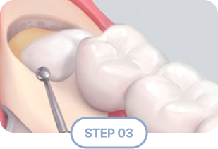 Extraction Step 3