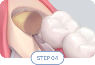 Extraction Step 4