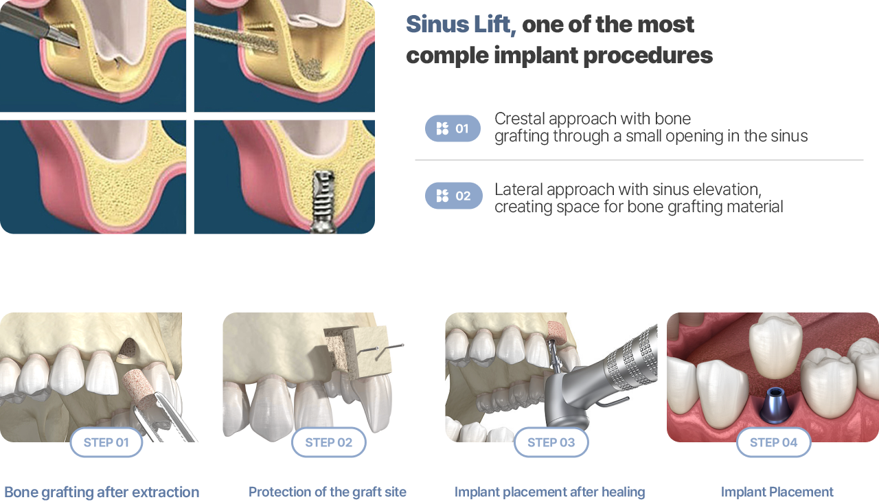 Sinus Lift