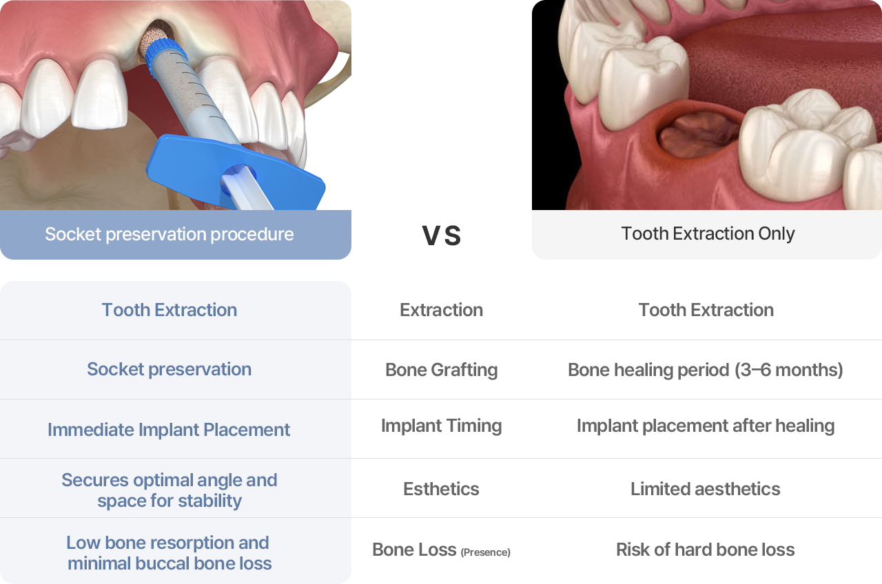Socket Preservation