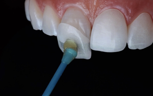 무삭제 라미네이트01