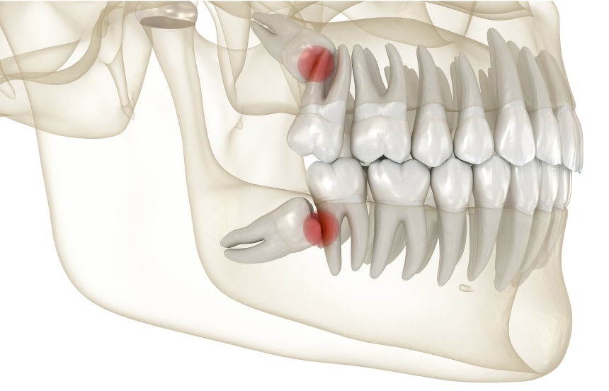 연세다감치과의 당일 사랑니 발치