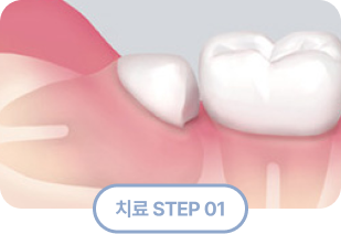 사랑니 발치 치료 순서1