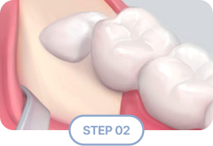 사랑니 발치 치료 순서2