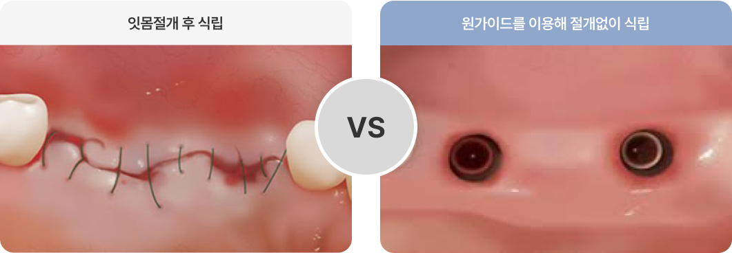 연세다감치과의 무절개 임플란트