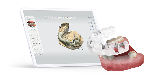 네비게이션 임플란트